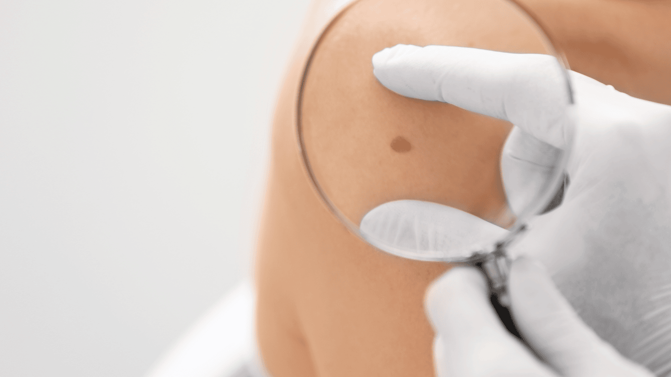 Doctor con guante mirando un melanoma en el omóplato a través de una lupa